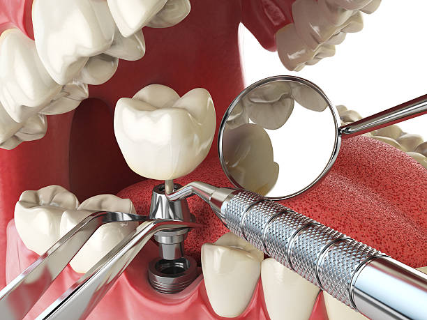 Urgent Tooth Repair in NJ